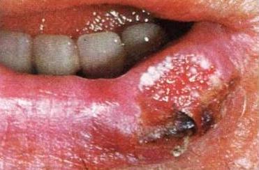 Spinalioma