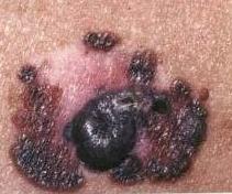 Melanoma