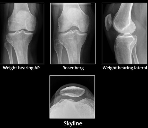 osteoarthritis orvosi kezelése