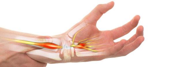 Így enyhíthető a kéztőalagút-szindróma