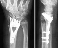 arthrosis 2 fokos kéz hogyan kell kezelni radonfürdők artrózis kezelésére