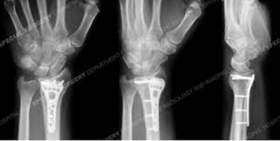pattanó ujj műtét utáni torna térdízület ízületi fájdalma a térd alatt húzódás