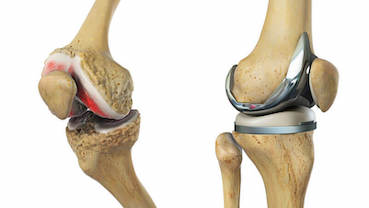 a jobb csípő artrózisa hogyan lehet megszabadulni a könyökfájástól