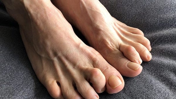a lábujjak és a lábak ízületi kezelése