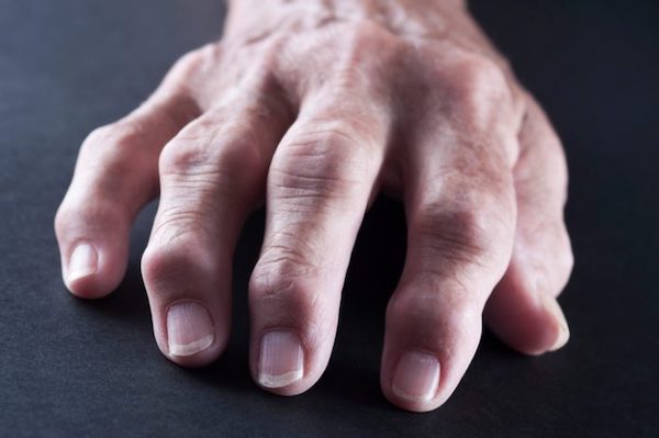 rheumatoid arthritis kizárási ízületek