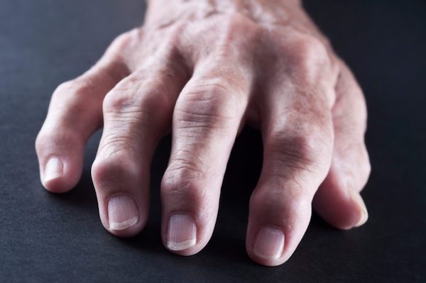 hogyan kezelhető a rheumatoid arthritis modern eszközökkel