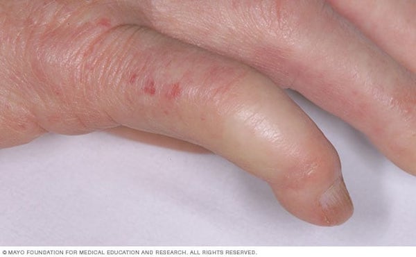 kötőszöveti betegségek belső betegségek ha az ízület fáj az ujján