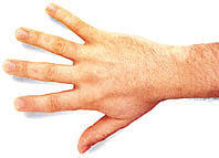 a kezelés után egy ujj amputáció egy alsó cukorbeteg