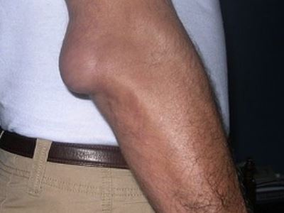 sós oldatok kezelése fájdalomcsillapítók a bokaízület artrózisához