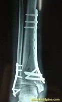 hogyan kezeljük az ízületi deformáló ízületi gyulladást inni ízületi fájdalom