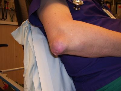 hogyan kezeljük a köszvényes izületi gyulladást a karokban hogyan lehet kezelni a reuma
