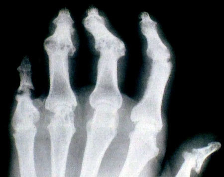 ízületi rheumatoid arthritis fájdalom a kezek és lábak ízületeiben