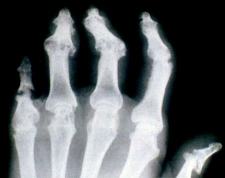 a rheumatoid arthritis ízületi betegségekre utal