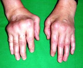 férfiak kezeinek rheumatoid arthritis