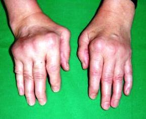 Reumatoid arthritis tünetei és kezelése