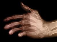 Arthritis psoriatica tünetei és kezelése