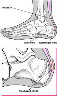 Nagy lábujj ízületi betegség kezelése. Arthrosis a lábkezelés 2 fázisa