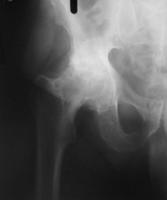 csípőízületek artrózisának kezelése műtét nélkül