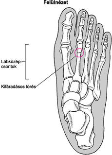 lábfej csontjai a jobb térdízület meniszci károsodása