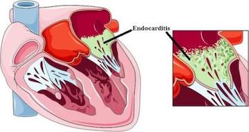 4 ok a szívizomgyulladás mögött - a COVID-on túl
