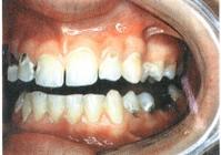 A foghúzás utáni csonthártyagyulladás tünetei és kezelése - Dentpoint