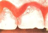 A dentális plakk felhalmozódása <br>következtében az ínyszélen <br>gyulladás alakult ki