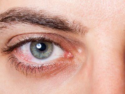 Mikor kell vörös szemnél kötőhártya-gyulladásra gondolni?