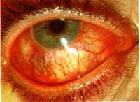 szemészet: száraz szem-szindróma