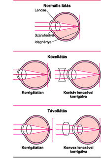 szemüveg a látási hibák kijavításához