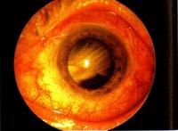 Antibiotikum és teniszlabda, avagy a retinaleválás okai, tünetei és kezelése