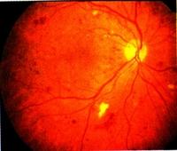 diabetes retinaleválás kezelésére