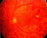 retinaleválás tünetei és kezelési módszerek