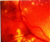 retinopathia hipertóniával