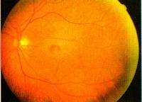 szemészeti retina degeneráció a társadalom különböző nézőpontokból