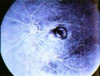 szemészeti retina degeneráció latin szem teszt táblázat