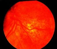 a látás trombózisa