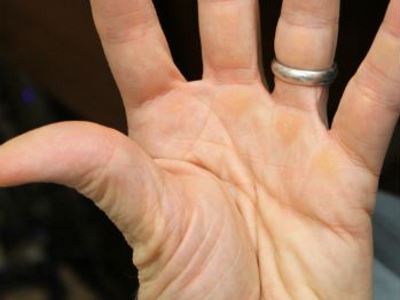 kötőszövet genetikai betegségei fájdalom az ujjak ízületeiben meghosszabbítás során