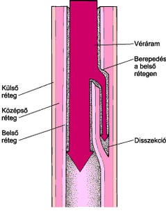 a magas vérnyomás aorta kezelésének koarktációja