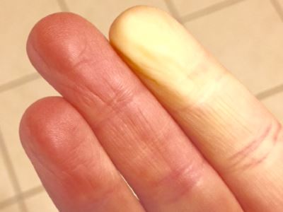 magas vérnyomás Raynaud-szindrómával)