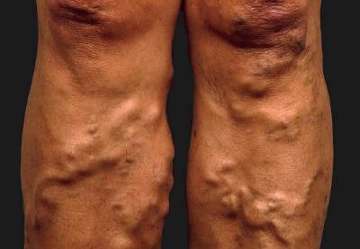 vásároljon gesztenyét visszér ellen belső visszér hogyan kell kezelni a népi gyógymódokat
