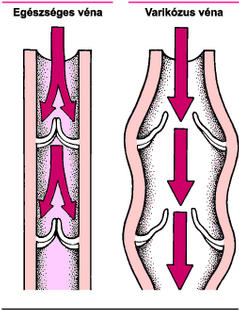 visszérrel a láb vénái fájnak