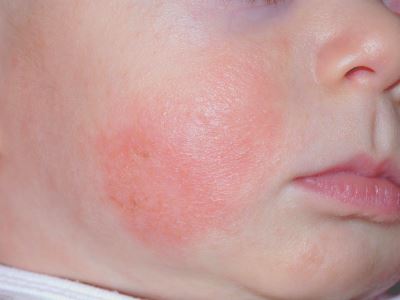 újszülött atópiás dermatitis