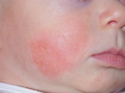 atópiás dermatitis vörös foltok az arcon