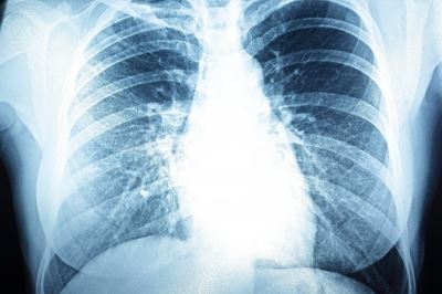 hogyan és hogyan kell kezelni a pulmonalis hipertóniát