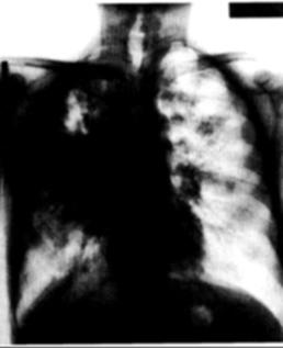 Tuberkulózis fogyás tünetei