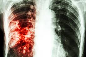 Tuberkulózis és dohányzás elleni védekezés, A dohányzás, mint a tbc egyik rizikófaktora