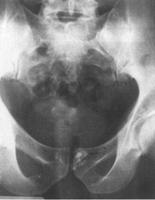 prostatitis balzsamok milyen antibiotikum krónikus prosztatitissel