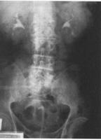 Krónikus prosztatitis krónikus urethritis - Навигация по записям