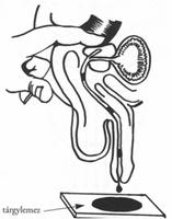 μb krónikus prosztatitis exacerbation