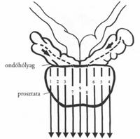 krónikus számos prostatitis dgpzh jelekkel